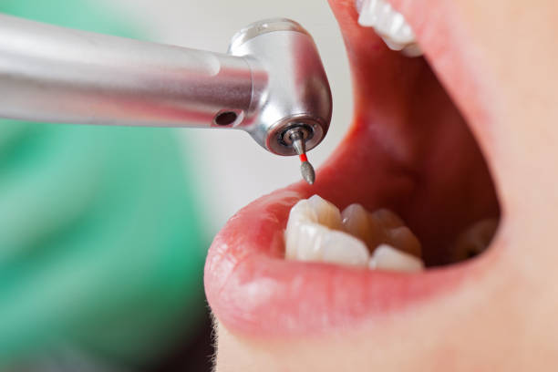 Best Emergency Dental Extractions in Mitchell, IL